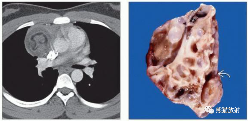 胸腺脂肪瘤、纵隔畸胎瘤影像表现-4