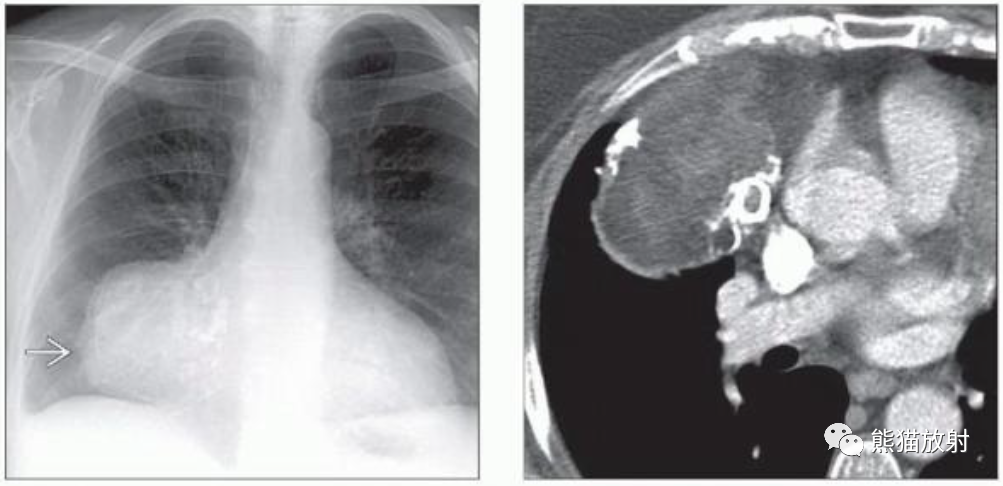 胸腺脂肪瘤、纵隔畸胎瘤影像表现-5