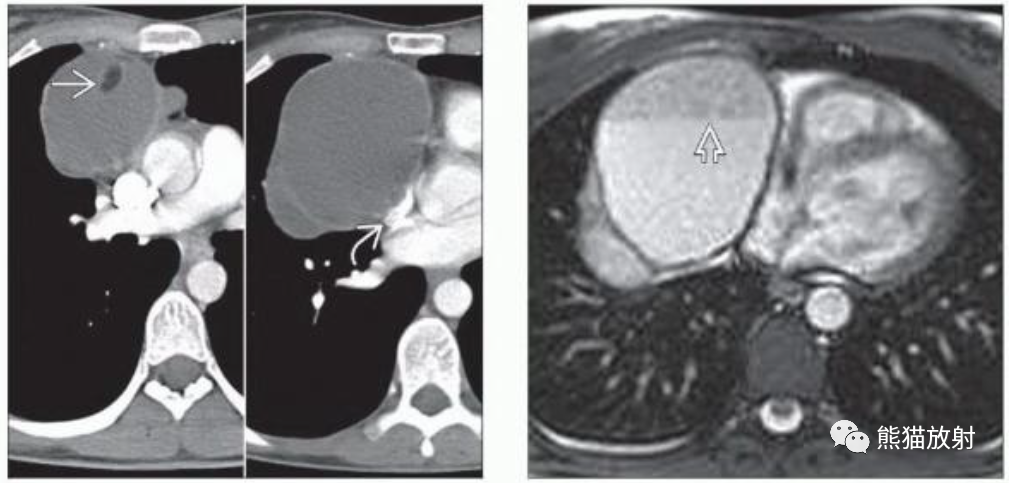 胸腺脂肪瘤、纵隔畸胎瘤影像表现-6