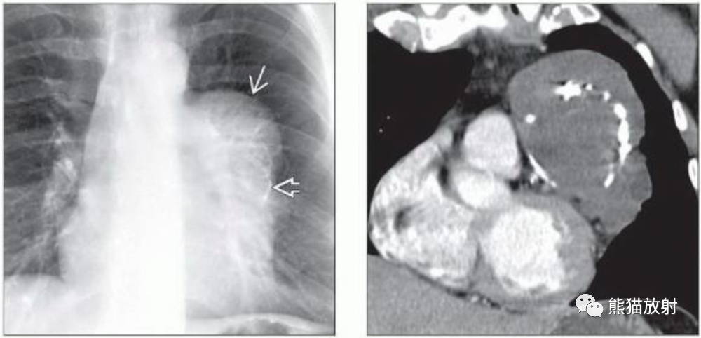 胸腺脂肪瘤、纵隔畸胎瘤影像表现-7
