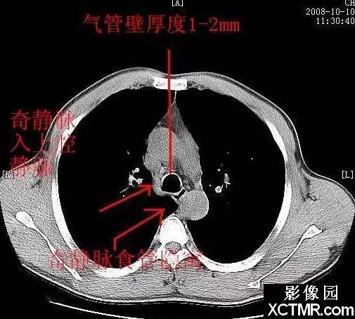 胸部CT断层解剖纵隔血管气管分支标注详解