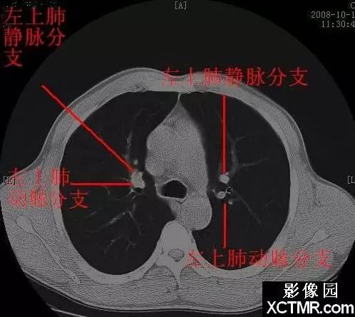 胸部CT断层解剖纵隔血管气管分支标注详解