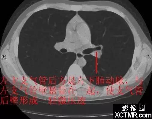 胸部CT断层解剖纵隔血管气管分支标注详解
