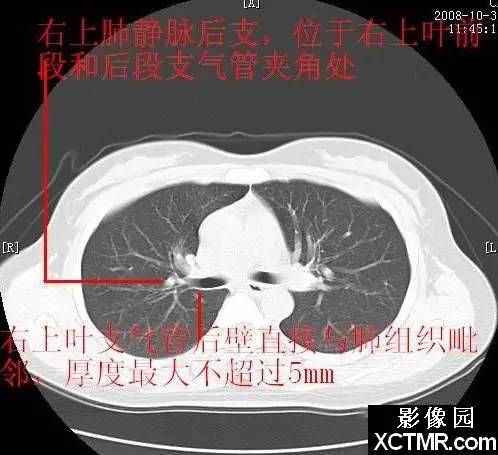 胸部CT断层解剖纵隔血管气管分支标注详解