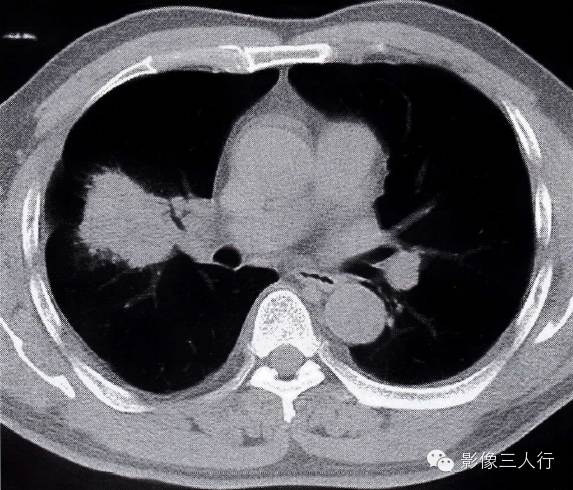 肺门区肺炎，“小心”不要误诊~~