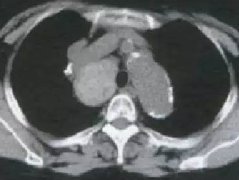 胸内甲状腺肿1例CT影像表现