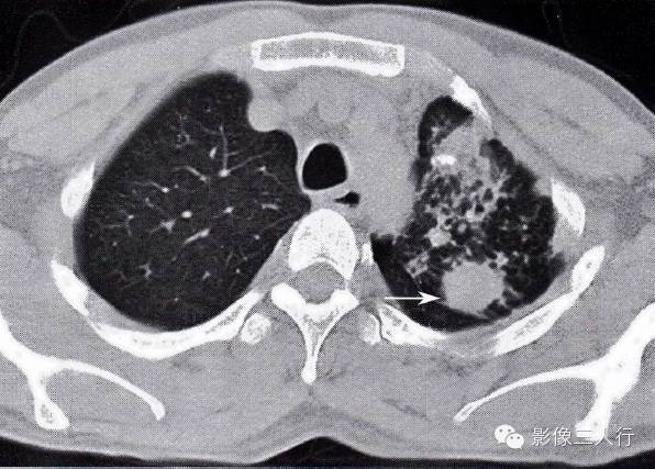 肺结核合并肺癌的CT表现及鉴别诊断