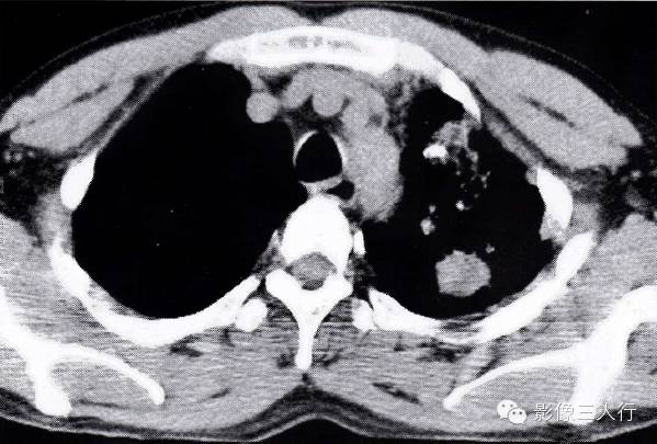 肺结核合并肺癌的CT表现及鉴别诊断