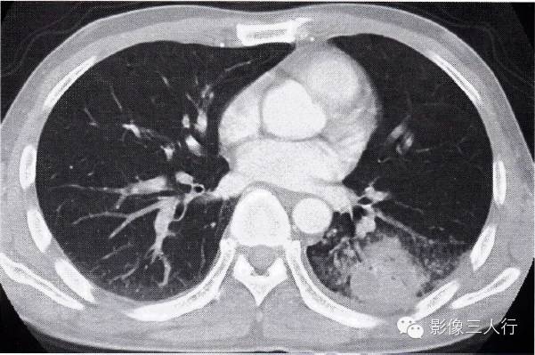 肺结核合并肺癌的CT表现及鉴别诊断