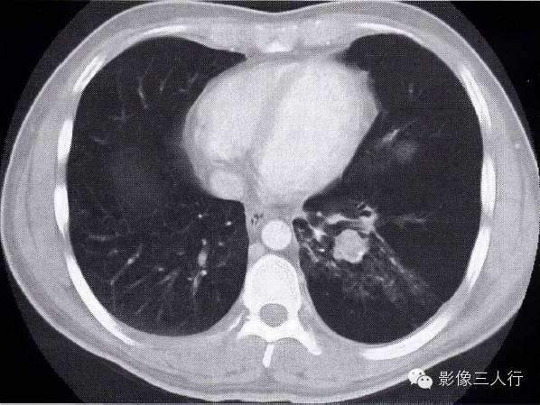肺结核合并肺癌的CT表现及鉴别诊断