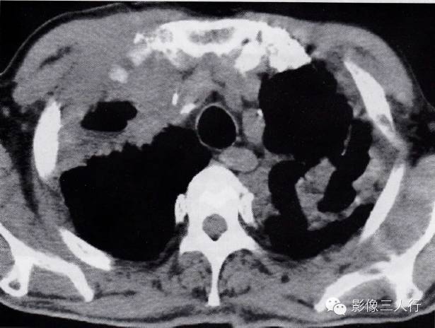 肺结核合并肺癌的CT表现及鉴别诊断