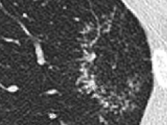 环礁岛征/反晕征—隐源性机化性肺炎2例CT影像