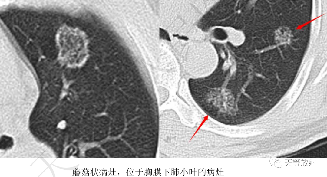 环礁岛征/反晕征-9