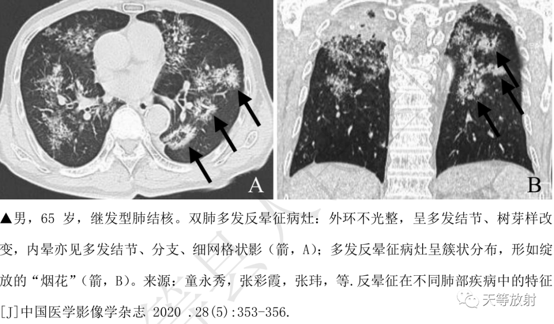 环礁岛征/反晕征-15