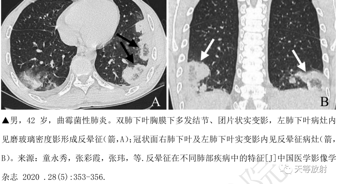 环礁岛征/反晕征-17