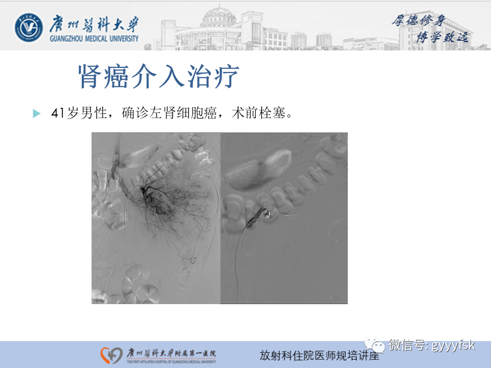 【PPT】肾血管解剖及介入治疗-14