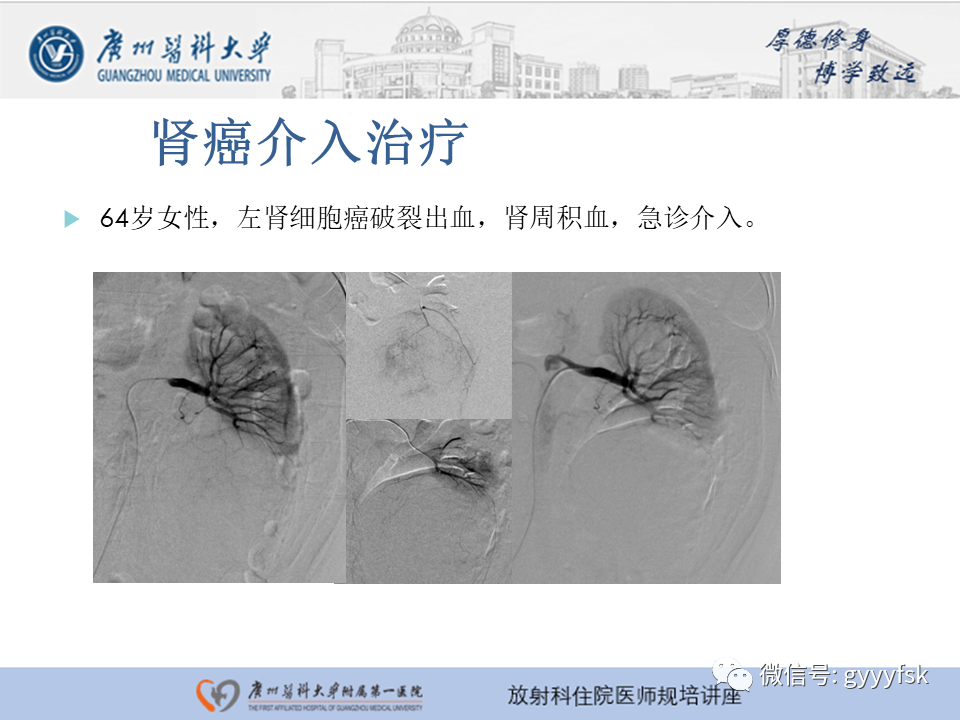 【PPT】肾血管解剖及介入治疗-15