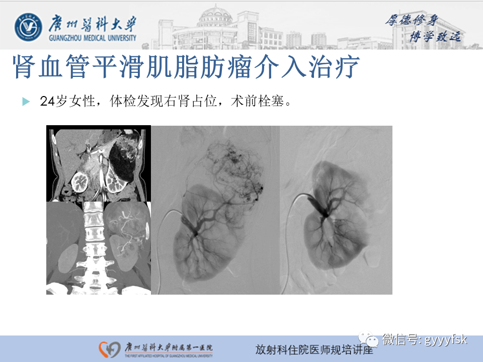 【PPT】肾血管解剖及介入治疗-18