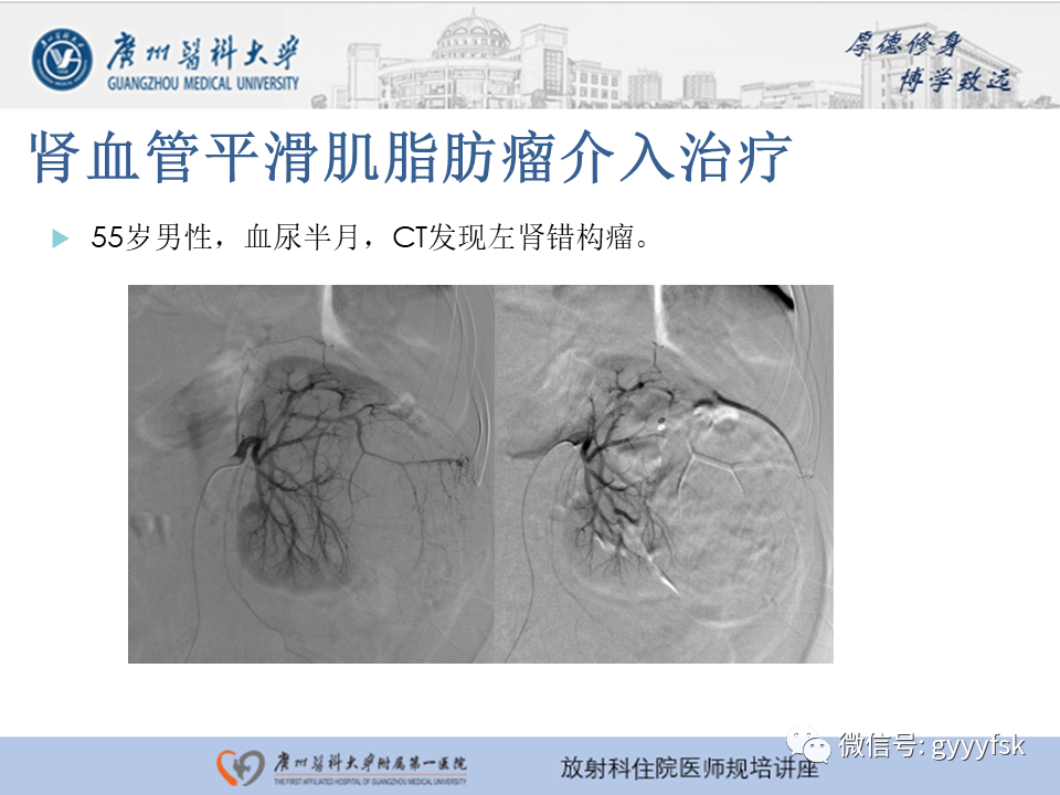 【PPT】肾血管解剖及介入治疗-19
