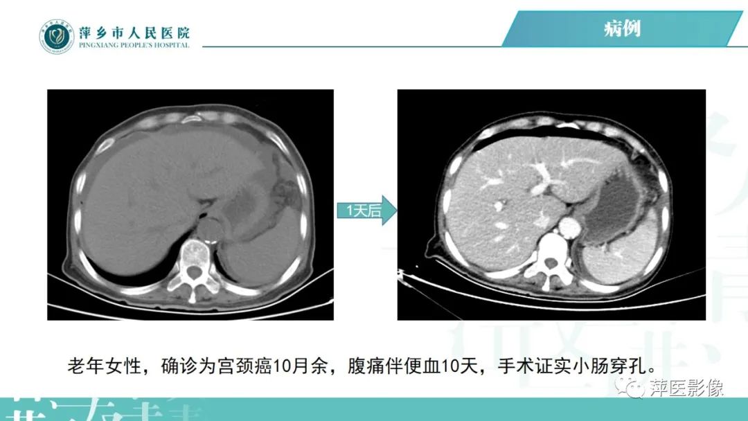 【PPT】腹腔游离气体-3