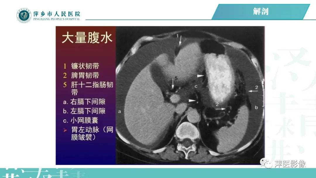 【PPT】腹腔游离气体-28