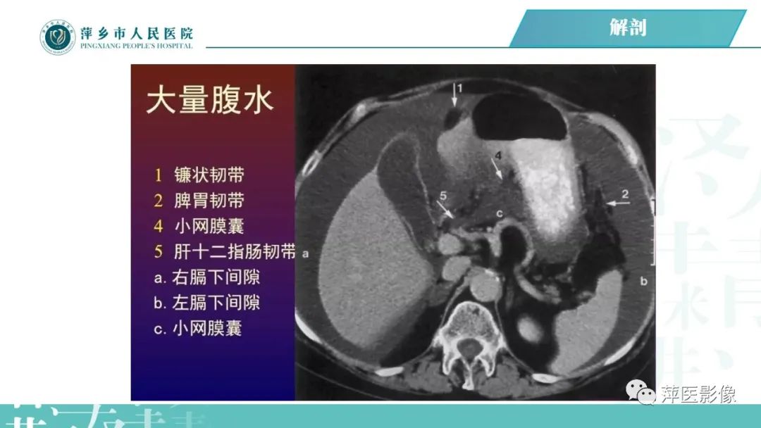 【PPT】腹腔游离气体-29