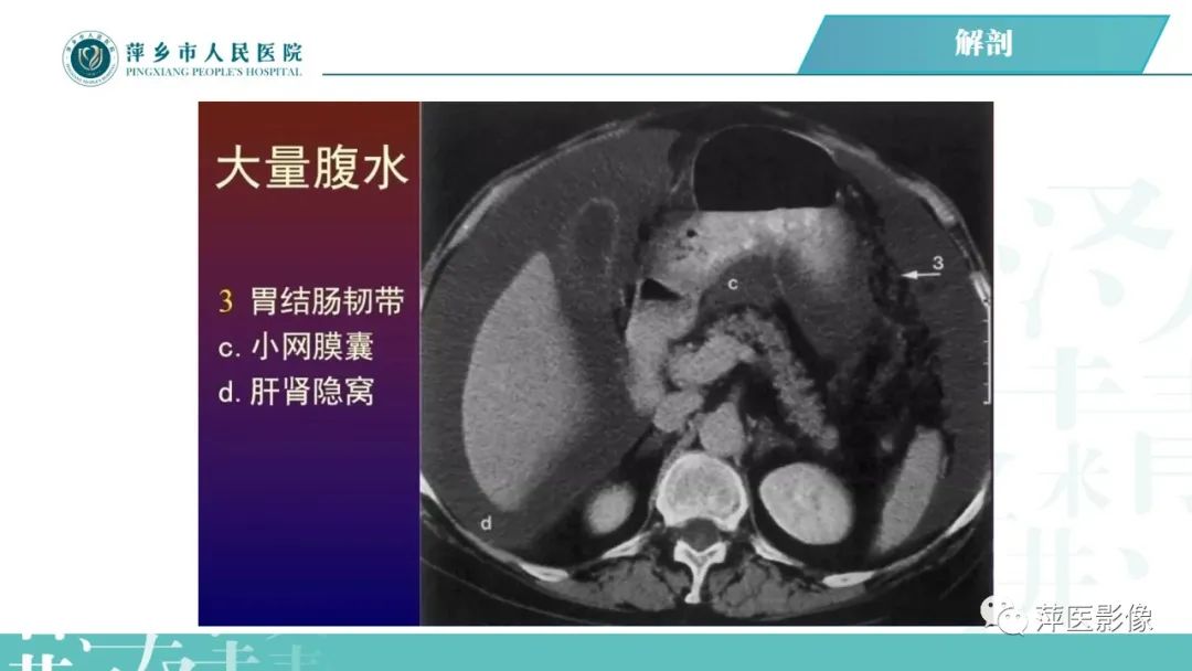 【PPT】腹腔游离气体-31