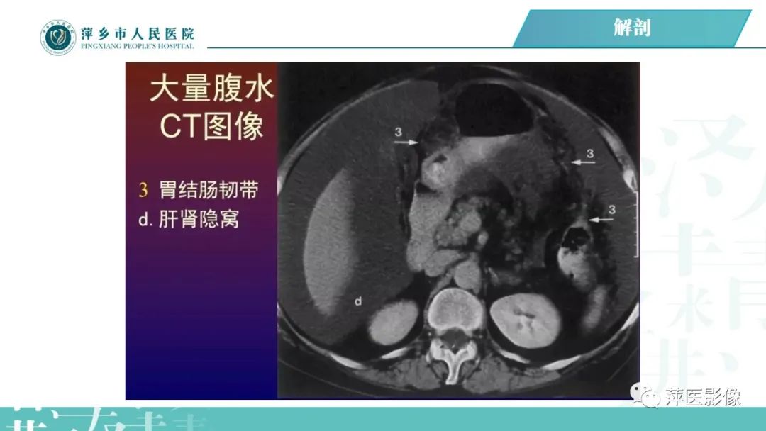 【PPT】腹腔游离气体-32