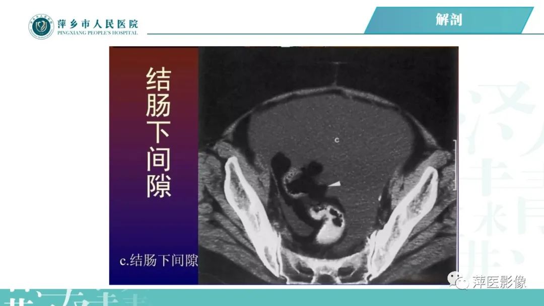 【PPT】腹腔游离气体-35