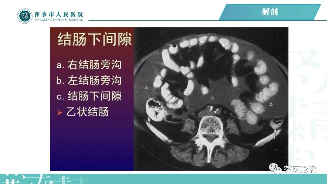 【PPT】腹腔游离气体-34