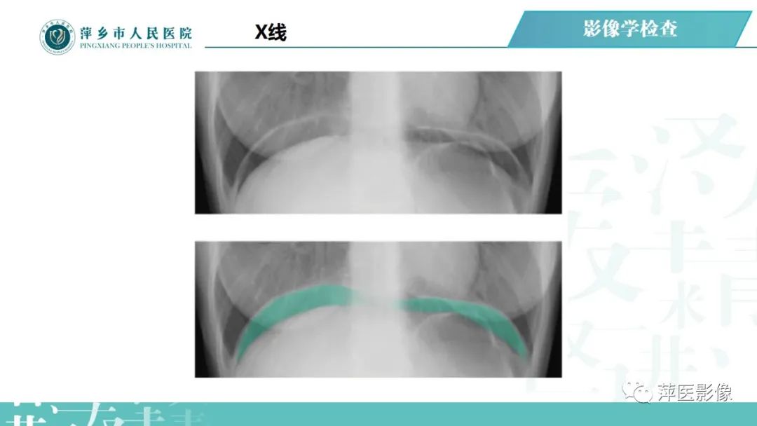 【PPT】腹腔游离气体-39