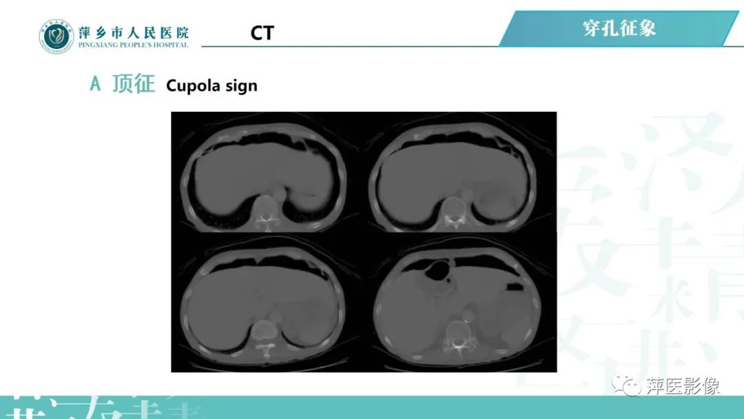 【PPT】腹腔游离气体-40