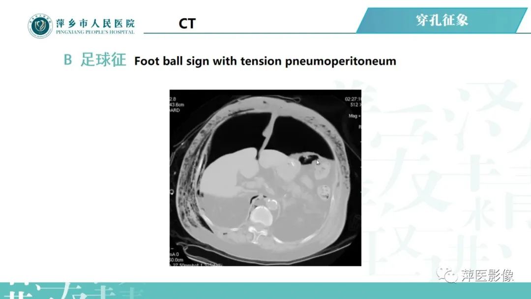 【PPT】腹腔游离气体-41