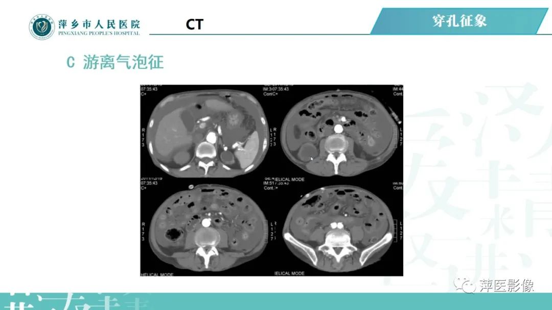 【PPT】腹腔游离气体-42