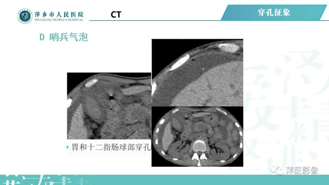 【PPT】腹腔游离气体-43