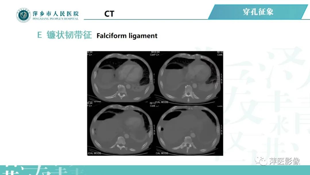【PPT】腹腔游离气体-44