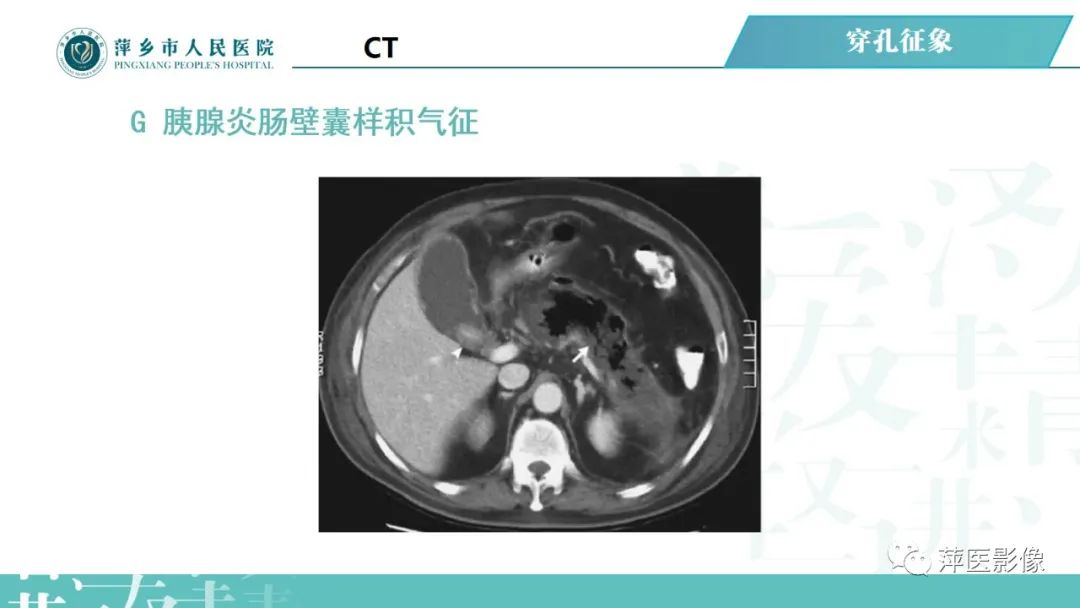 【PPT】腹腔游离气体-46