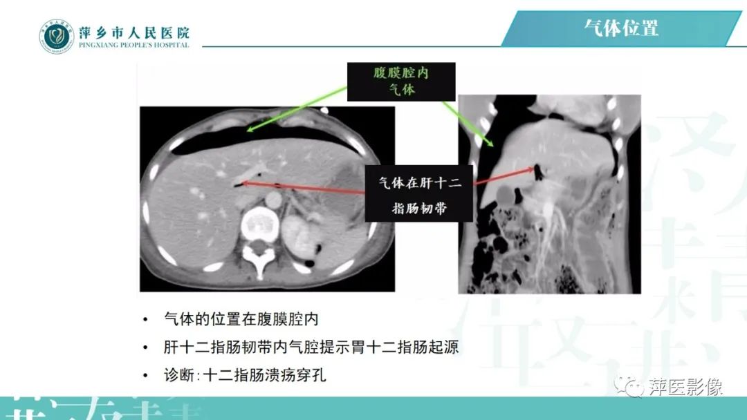 【PPT】腹腔游离气体-48