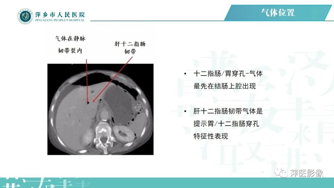 【PPT】腹腔游离气体-49
