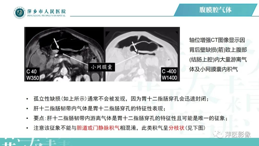 【PPT】腹腔游离气体-50