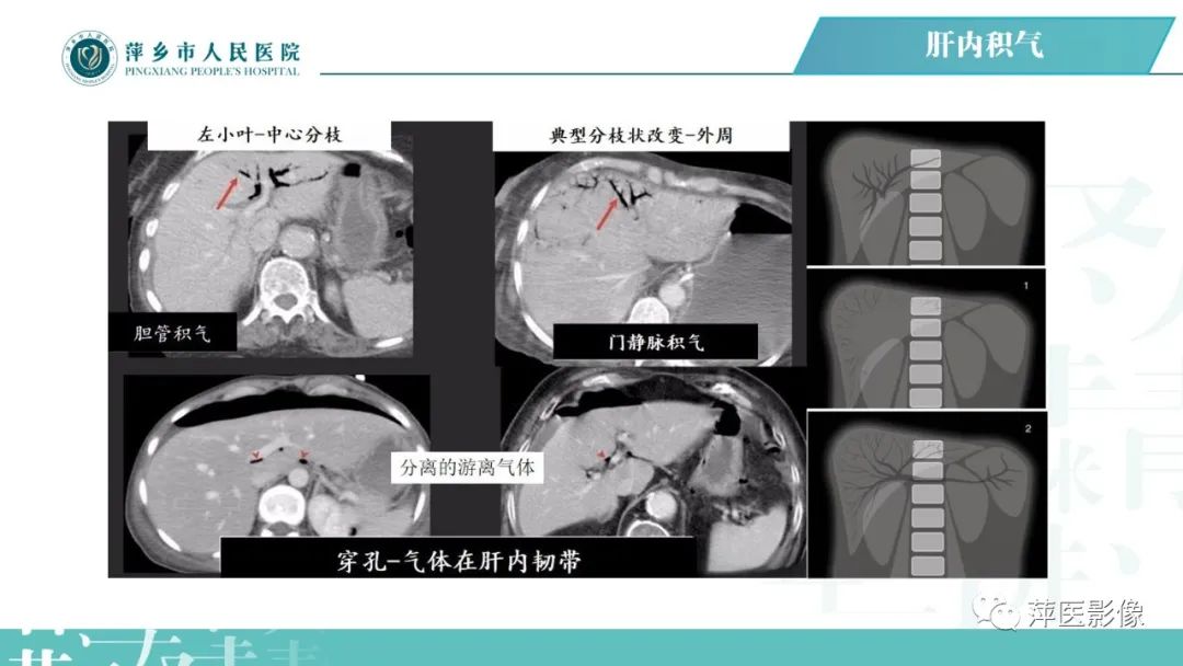 【PPT】腹腔游离气体-51