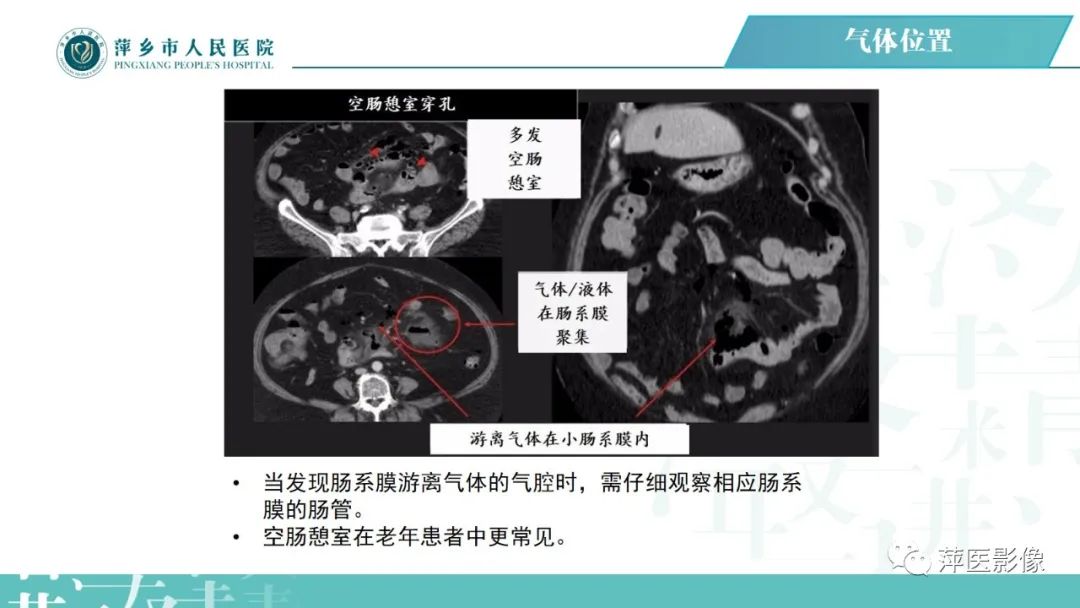【PPT】腹腔游离气体-53