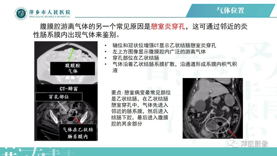 【PPT】腹腔游离气体-52
