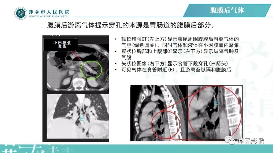 【PPT】腹腔游离气体-55