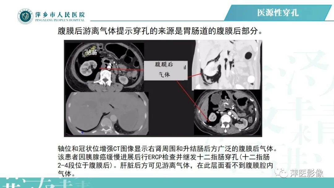 【PPT】腹腔游离气体-56