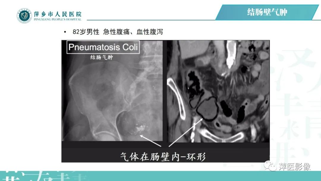 【PPT】腹腔游离气体-57