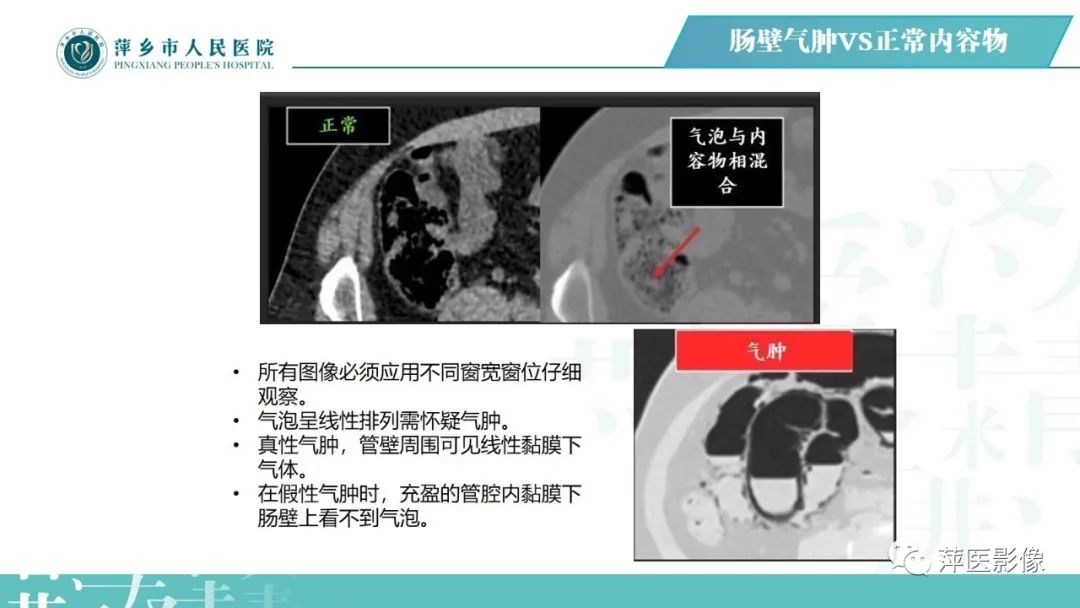 【PPT】腹腔游离气体-58