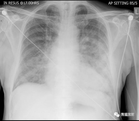 肺部之“蝙蝠翼征”-2