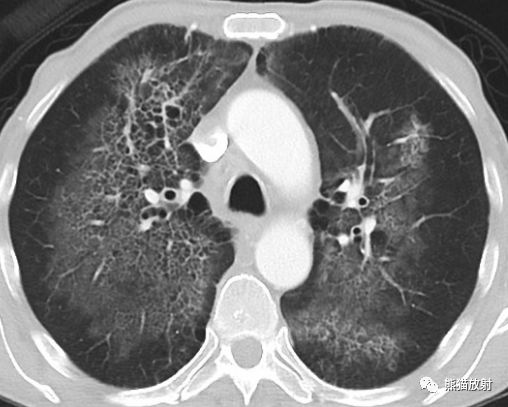 肺部之“蝙蝠翼征”-3