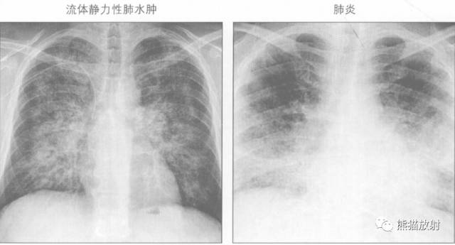 肺部之“蝙蝠翼征”-9